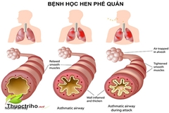 Hen phế quản