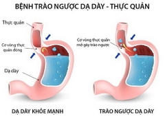 Trào ngược dạ dày - thực quản gây ra đau, tức ngực