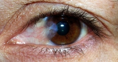 Bệnh mộng mắt - Những điều bạn cần biết khi điều trị mộng mắt