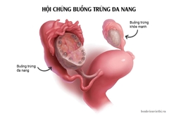 Làm sao để biết được mình có bị Buồng trứng đa nang hay không?