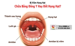 Bị viêm họng hạc đông y điều trị hay đốt họng hạc?