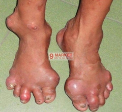 Cao Gắm - Đặc trị Gout và xương khớp