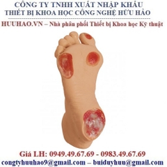 MÔ HÌNH THỰC HÀNH CHĂM SÓC VẾT LOÉT BÀN CHÂN V0950 NASCO