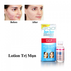 Trị Mụn Bye Bye Blemish Drying Lotion của Mỹ