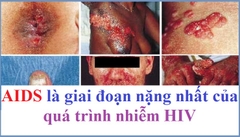 Hậu quả của AIDS dù đã qua giai đoạn nguy kịch?