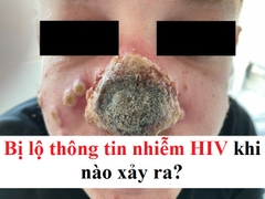 Bị lộ thông tin nhiễm HIV khi nào?