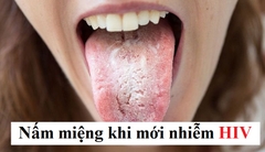 Dấu hiệu nấm miệng khi mới nhiễm HIV như thế nào?