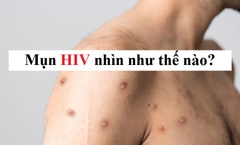 Mụn HIV nhìn như thế nào?