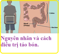 Nguyên nhân và cách khắc phục táo bón kinh niên?