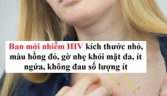 Dấu hiệu phát ban khi mới nhiễm HIV như thế nào?