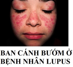 LUPUS BAN ĐỎ LÀ BỆNH GÌ, CHẨN ĐOÁN VÀ ĐIỀU TRỊ LUPUS BAN ĐỎ RA SAO?