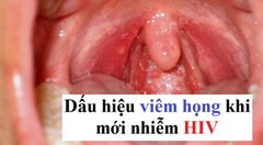 Dấu hiệu viêm họng khi mới nhiễm HIV như thế nào?