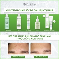 Serum kiềm dầu se khít lỗ chân lông cho da dầu Dermedic Normacne Preventi Widened Pores Serum 30ml