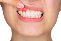 Vệ sinh răng miệng tránh tình trạng viêm lợi đúng cách cập nhật 2024
