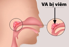 Dấu hiệu viêm V.A mãn tính ở trẻ nhỏ