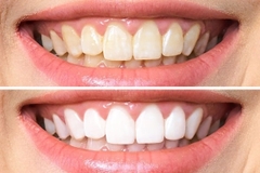 Nên tẩy trắng răng tại nhà hay tới nha khoa?