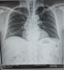 Hình ảnh X Quang ngực cho thấy: -	Hình ảnh đám mờ nhẹ vùng đáy phổi phải.