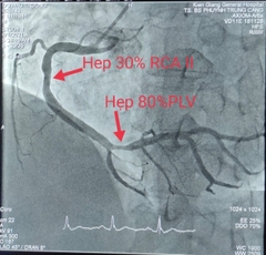 Còn hẹp 80% nhánh liên thất sau hẹn đặt stent sau 1 tuần.