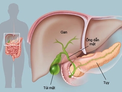 Các biểu hiện của bệnh gan nhiễm mỡ