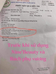 Bách Phụ Vương 40 Viên Hỗ Trợ Điều Trị U Xơ Tử Cung, U Xơ Tuyến Vú, U Xơ Tiền Liệt Tuyến, Giảm Sự Phát Triển của U Xơ Tử Cung, U Xơ Tuyến Vú, U Xơ Tuyến Tiền Liệt, Phì Đại Lành Tính Tiền Liệt Tuyến Phan An Green Nine's Beauty