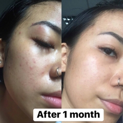 Gel Chấm Mụn Cấp Tốc T-Zone Skincare Spot Zapping Gel 8ml