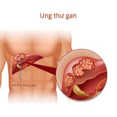 Những điều cơ bản cần biết về ung thư