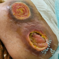 Lành 2 vết loét tì đè sau 1 tháng