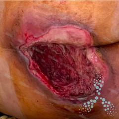 Cải thiện loét tì đè ở người lớn tuổi gãy cổ xương đùi