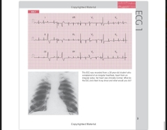 Sách ngoại văn 150 ECG Cases 5th