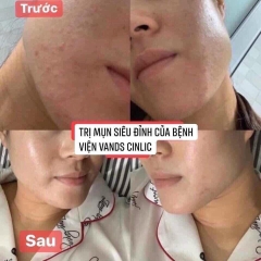 Tinh chất trị mụn  jangstem bệnh viện vands clinic 24kw