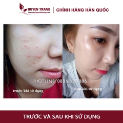 Tế Bào Gốc Hàn Quốc CUTISCURA Mụn Thâm Sau Mụn - Chăm sóc da mụn (10ml/lọ) - Thẩm Mỹ Huyền Trang NANOCEE