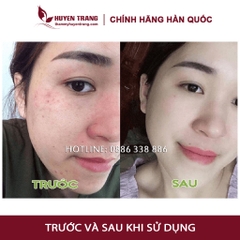 Serum Tế Bào Gốc Hàn Quốc CUTISCURA Nám Tàn Nhang (10ml/lọ) Thẩm Mỹ Huyền Trang NANOCEE