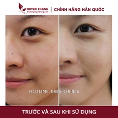 Tế Bào Gốc Tái Tạo Da CUTISCURA Hàn Quốc Giảm Sẹo Rỗ Giúp Da Mịn Màng (10ml/lọ) - Thẩm Mỹ Huyền Trang NANOCEE