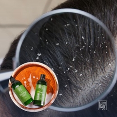 Làm Sao Phân Biệt Gàu Do Da Đầu Dầu Và Gàu Do Khô Da?