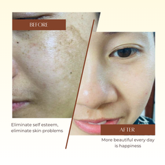 Melasma Serum Ladeen 20ml