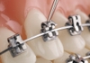 Khuyến mãi giảm 20% dịch vụ Niềng Răng