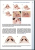 Sách   rhinoplasty  for the Asian Nose, An Issue of Facial Plastic Surgery  Clinics of North America