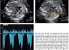 Sách echocardiographic anatomy in the fetus