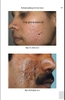 Sách  Step by Step Treatment of Acne Scars 