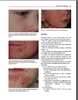 Sách acne: causes and practical management