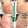 BEOTUA 20G- KEM HỖ TRỢ GIẢM MỤN KIỂM SOÁT DẦU THU NHỎ LỖ CHÂN LÔNG DƯỠNG ẨM LÀM TRẮNG DA HIỆU QUẢ