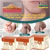 HŨ KEM THẢO MỘC LOẠI BỎ ĐÁNH TAN U MỠ BƯỚU CỔ NANYANG LIPOMA 30GR