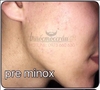 Combo Thuốc mọc râu Minoxidil 5% dạng lỏng + Biotin