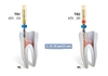 File dẻo 2shape hãng Micro Mega (Pháp) - Điều Trị Nội Nha