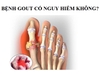 Bệnh gout có nguy hiểm?