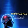 Thiểu Năng Tuần Hoàn Não: Sát Thủ Âm Thầm Gây Đột Quỵ