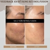 Retinol 1.0 Fusion Meso Therapy điều trị chuyên sâu đẩy mụn, mờ nám, nếp nhăn và lão hoá