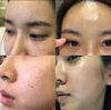 Kem vi gai tái tạo,tăng sinh collagen, mờ nám, trắng da MediShyn Diamond Stemcell Absolute Peel Cream