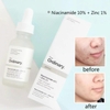 SERUM NGỪA MỤN, SÁNG DA, SE KHÍT LỖ CHÂN LÔNG NIACINAMIDE 10% + ZINC 1% THE ORDINARY