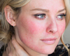 Cấp cứu làn da bị trứng cá đỏ (Rosacea), chứng đỏ da (Couperose)